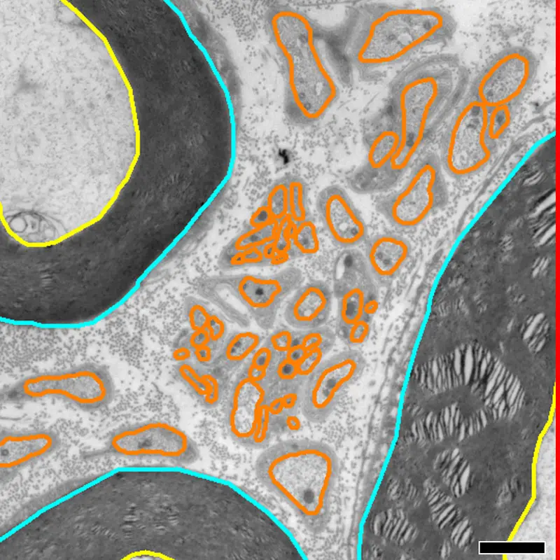 Outer and inner borders of myelinated axons shown in light blue and yellow, respectively; outline of unmyelinated axons is contoured in orange. Digital measurements of nerve fiber area and perimeter from each axon are used to determine a corrected value of fiber size based on SAE approach. Scale: 1 µm
