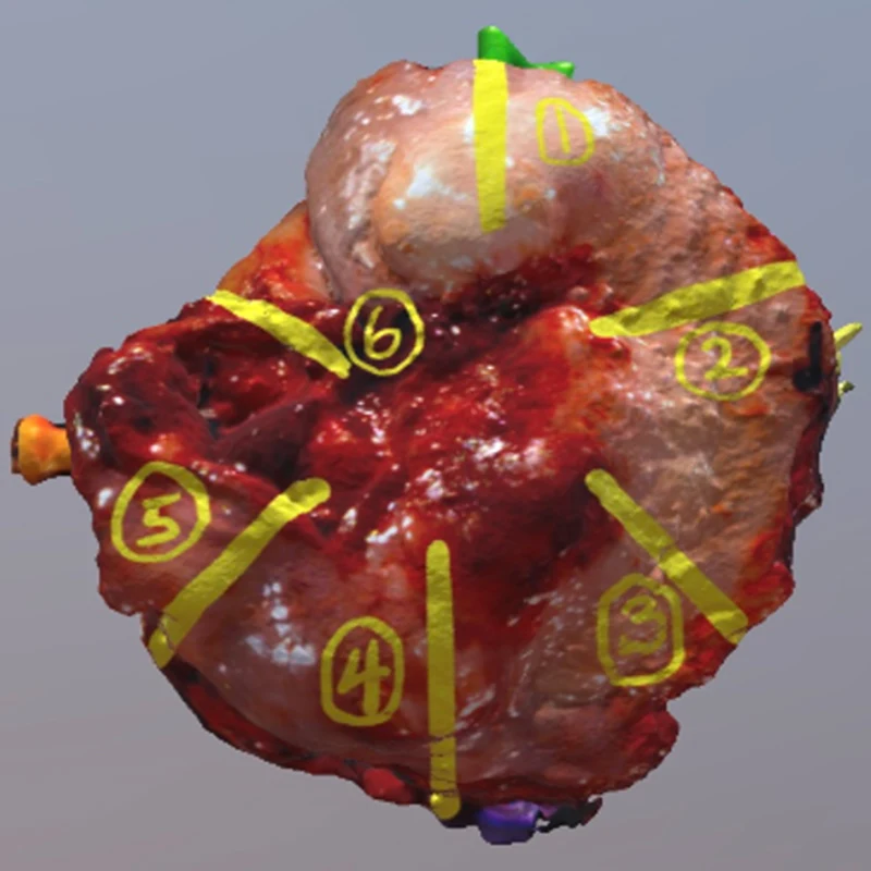 3D image of a scanned partial glossectomy specimen.