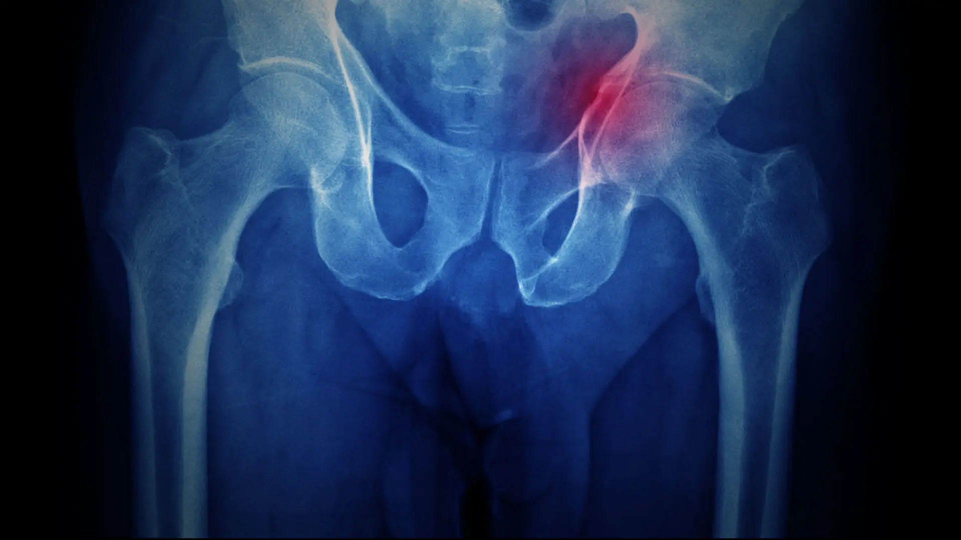 A New Model of Care for Hip Fracture Patients