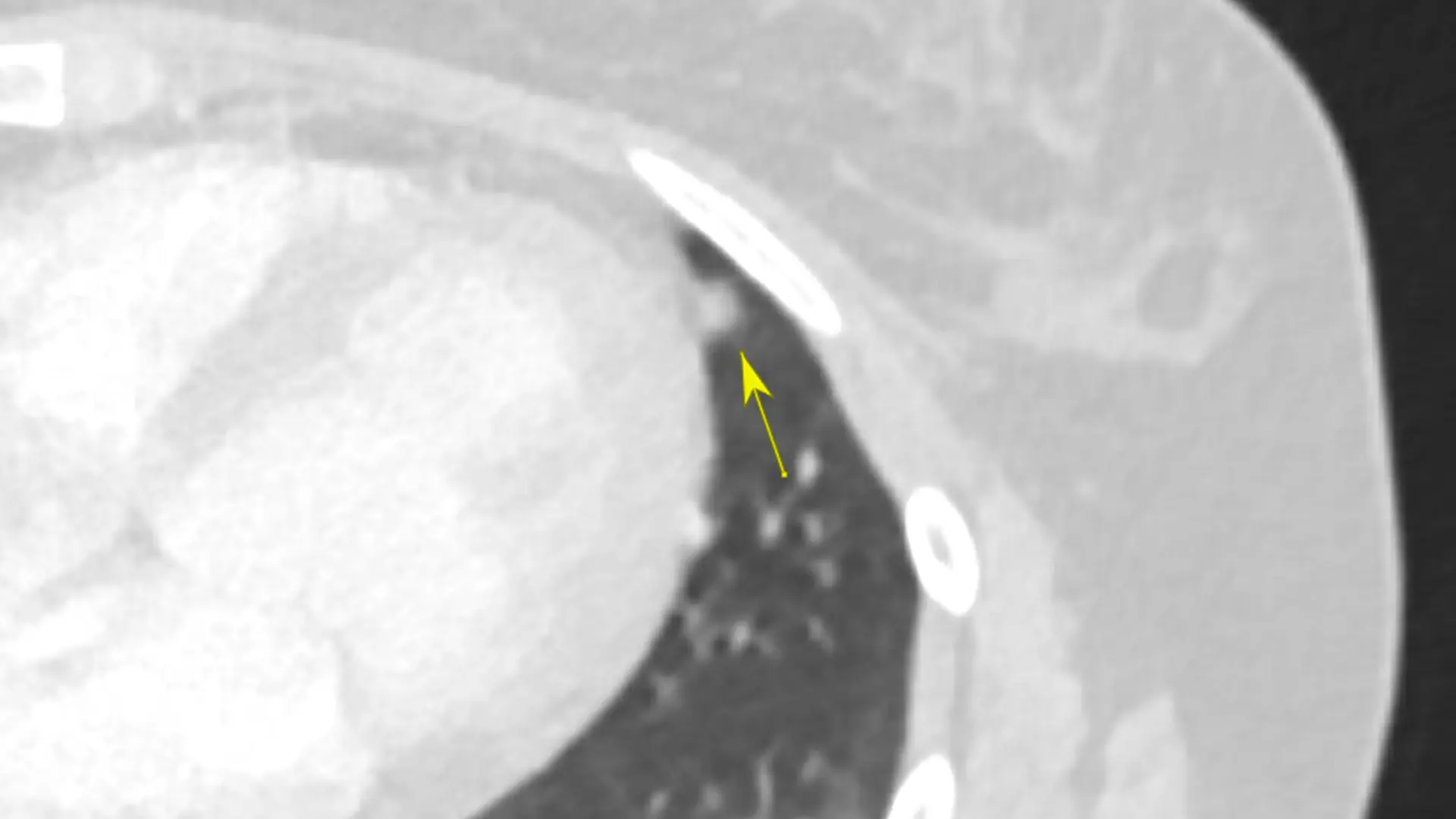 Solid nodule lingual 5 mm: according to Fleischner guidelines, in high-risk people this requires a follow-up in 12 months with a new CT.