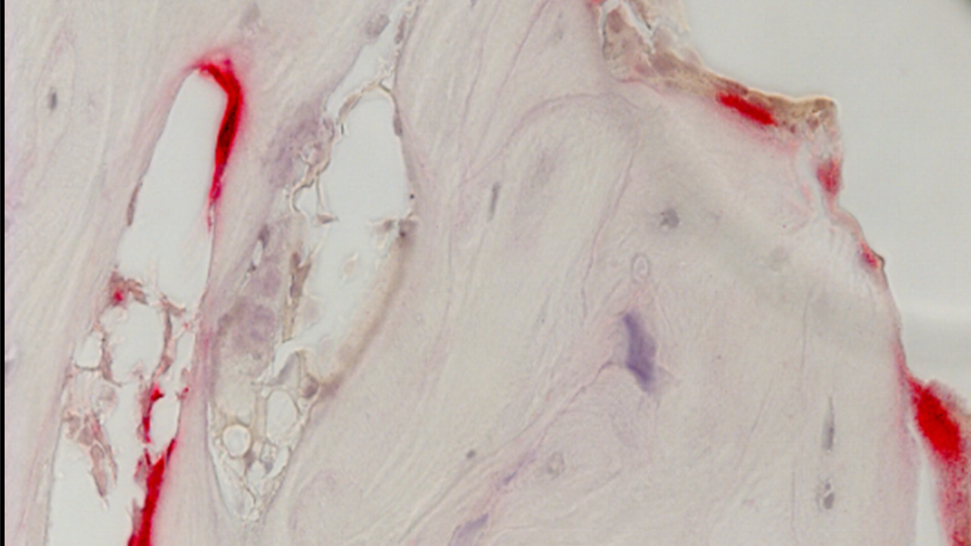 Probing the Hidden Link Between Osteoporosis and Alpha-1 Antitrypsin Deficiency