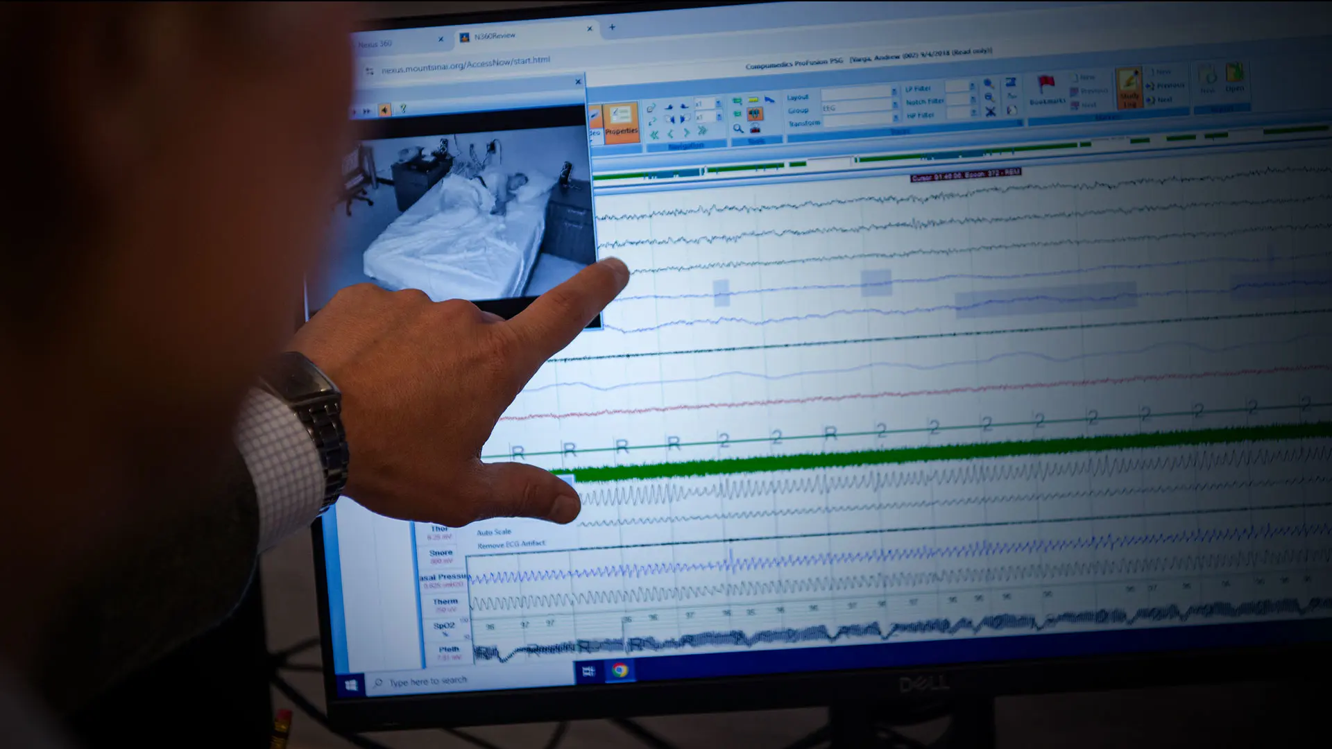 Biomarkers May Help Quest for a Link Between Apnea and Alzheimer's