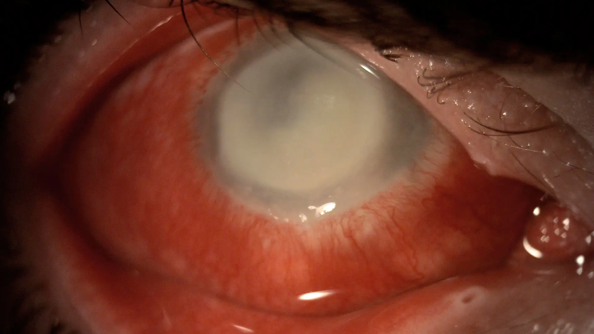 Slit lamp photo of the right eye demonstrating dense corneal infiltrate extending to the corneal
 limbus, with significant conjunctival injection and focal areas of scleral involvement. Visual acuity is
 counting fingers.