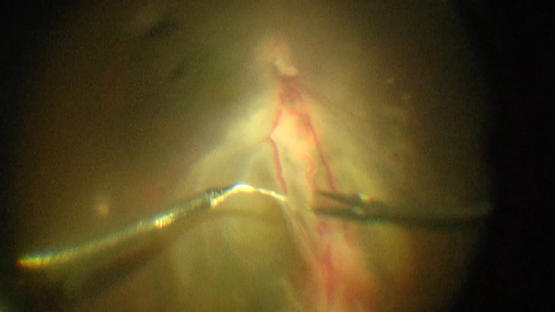 Ligation of the two abnormal vessels using intraocular forceps and sutures 