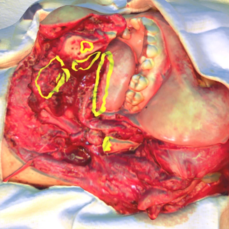 3D scanned image of a defect following a partial mandibulectomy and floor of mouth resection. Annotations indicate the precise location and breadth of supplemental margins harvested.