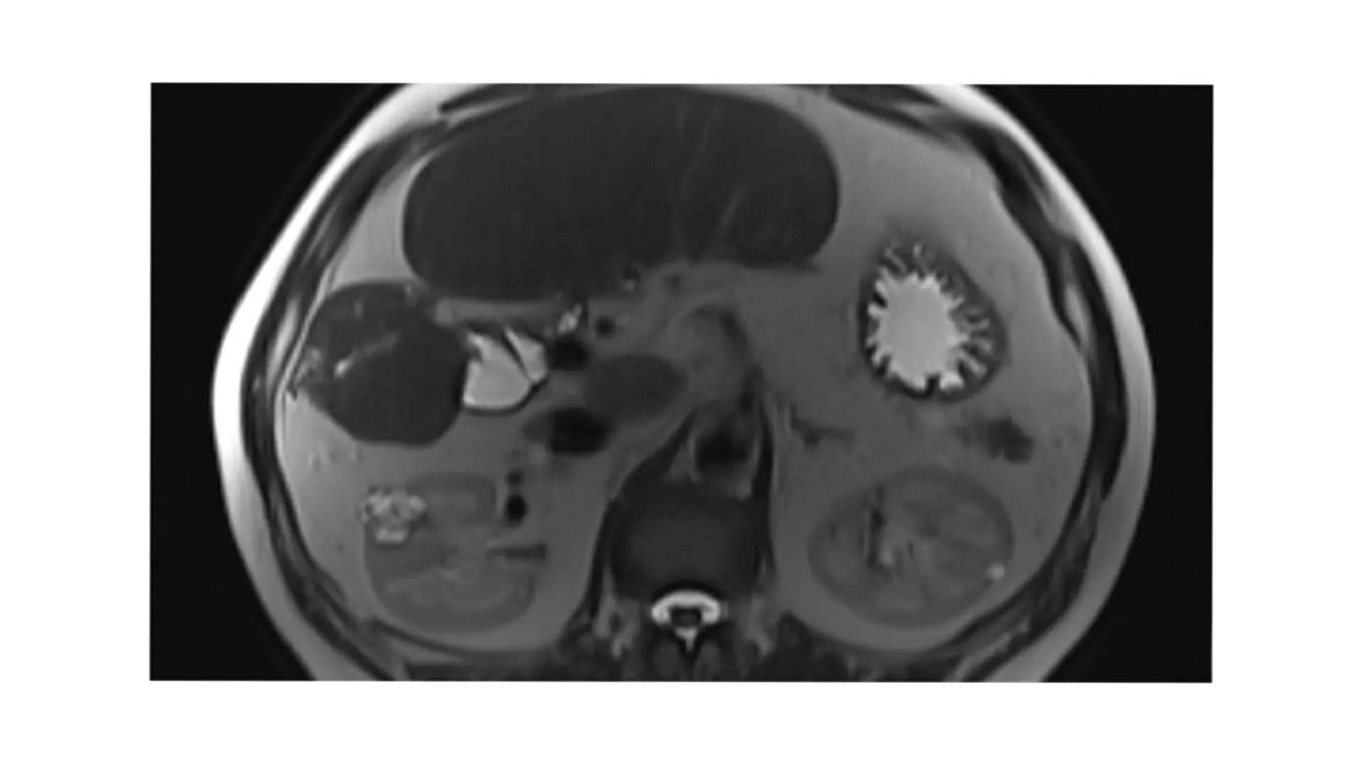 An anterior tumor on the kidney that is ideal for the retroperitoneal approach



