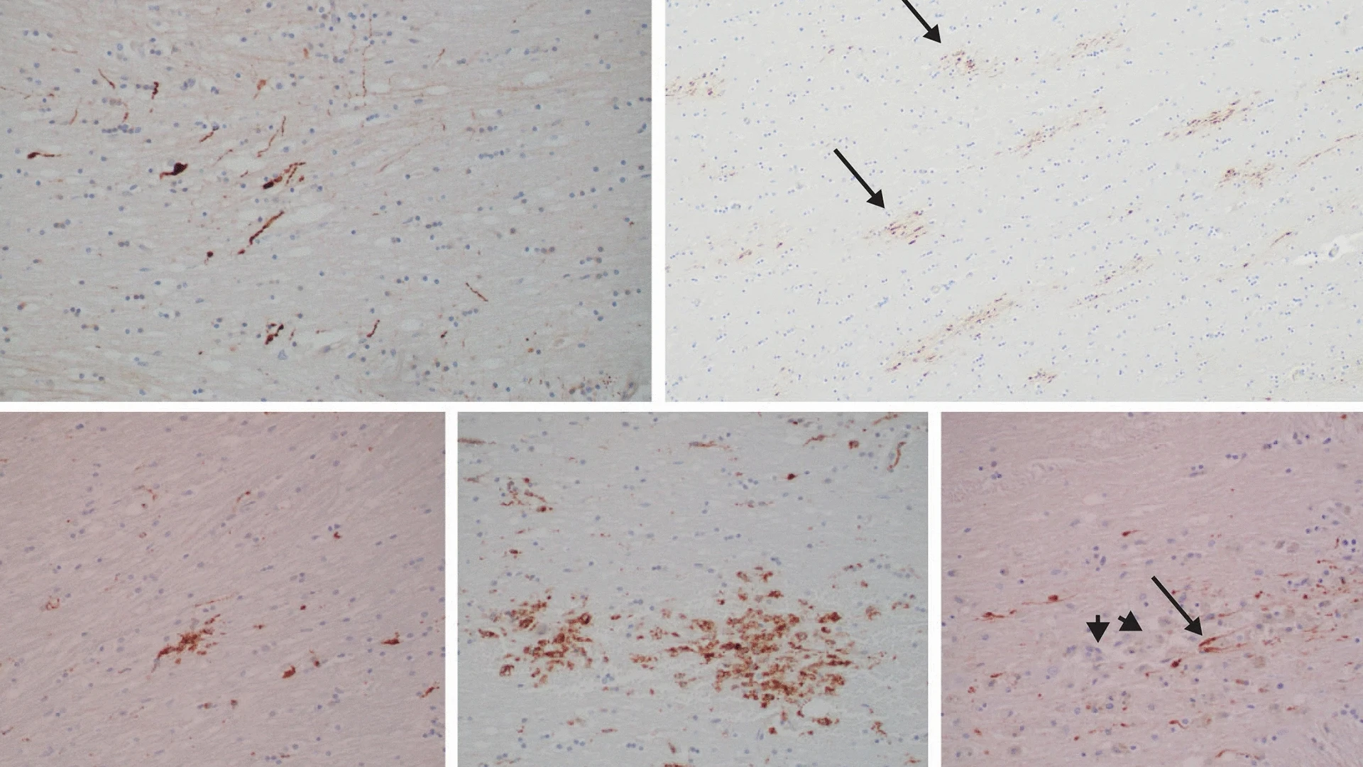 In microscopic inspections of the corpus callosum, internal capsule, and dorsolateral brainstem, acute diffuse axonal injury was found, with CD68-immunoreactive microglia, consistent with post-traumatic brain injury and associated ongoing neuroinflammation and axonal degeneration.