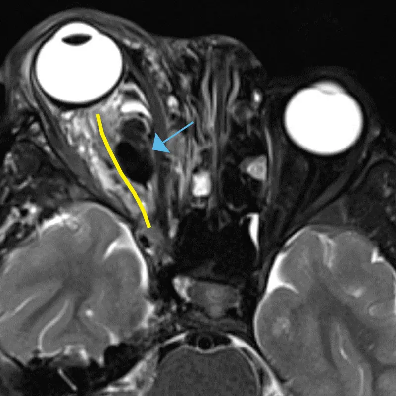 Axial MRI showing optic nerve course (yellow line) with compression by AVM (blue arrow)