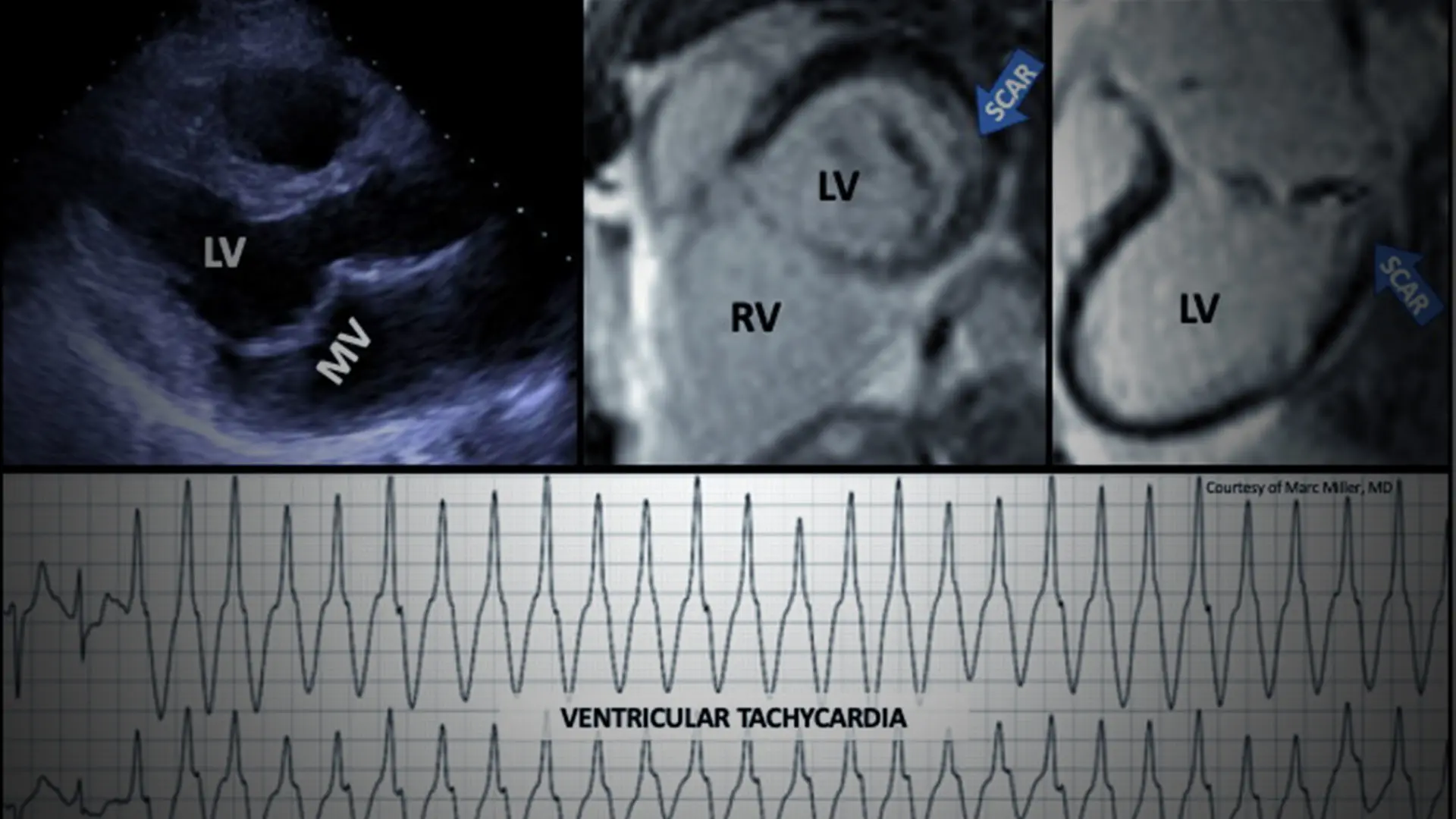 $10.2 Million NIH Grant to Explore the Early Signs of Arrhythmic Mitral Valve Prolapse