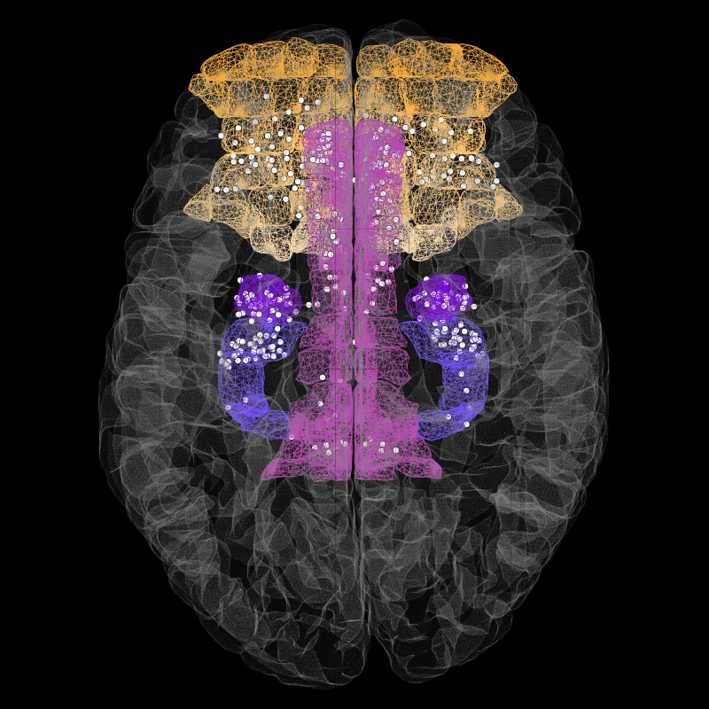 Figure 2. Composite image showing the location of invasive stereotactic electrodes (white dots) implanted deep in the brain of several patients with intractable epilepsy.