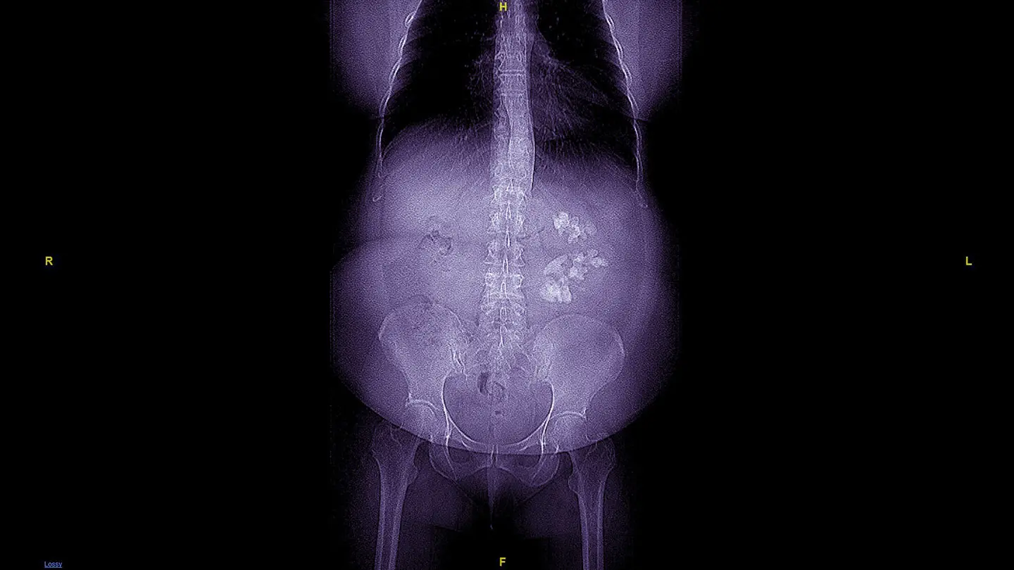 A More Comprehensive, Patient-Centered Approach to Staghorn Calculi
