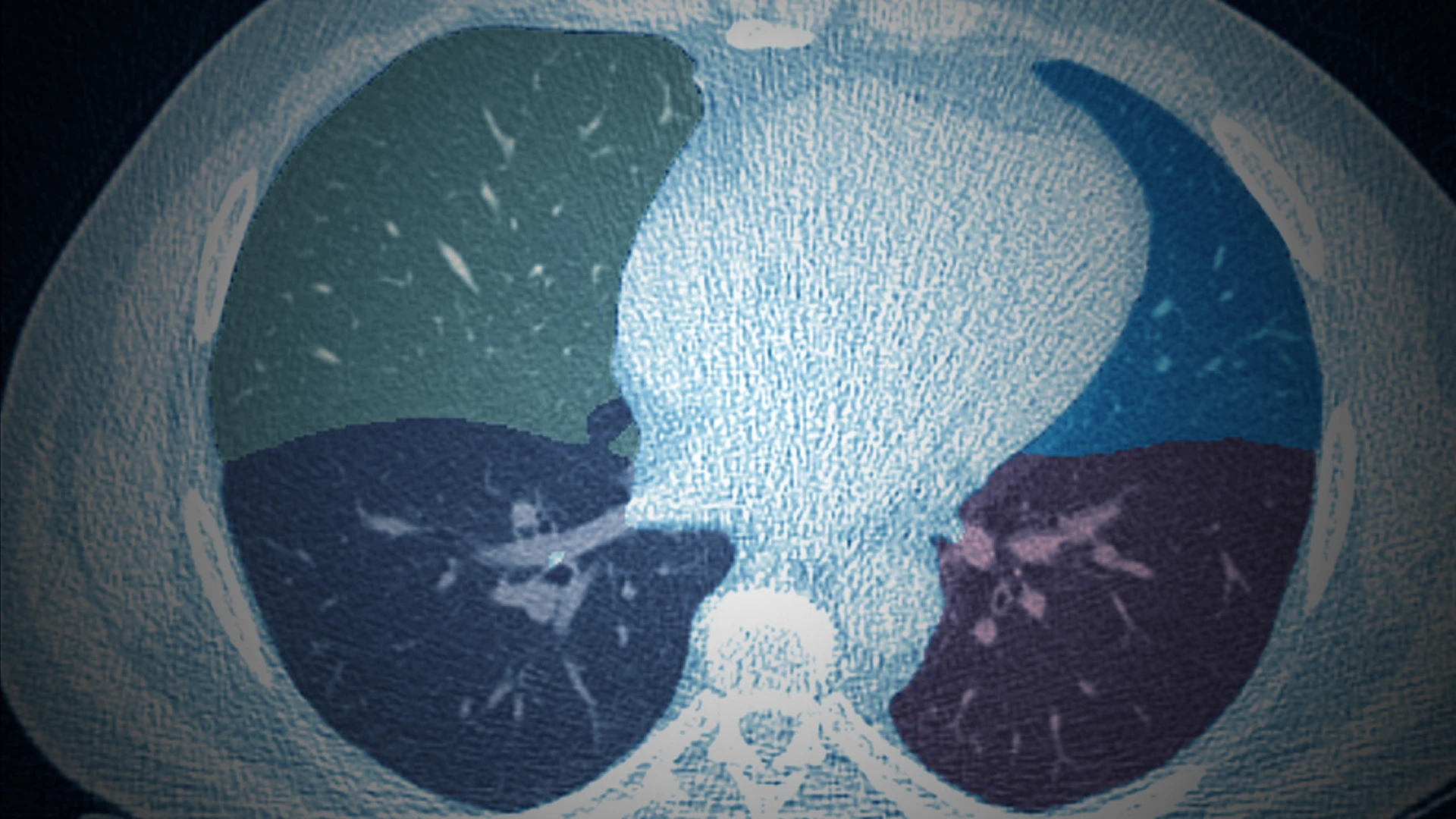 Transforming Lung Cancer Screening With AI