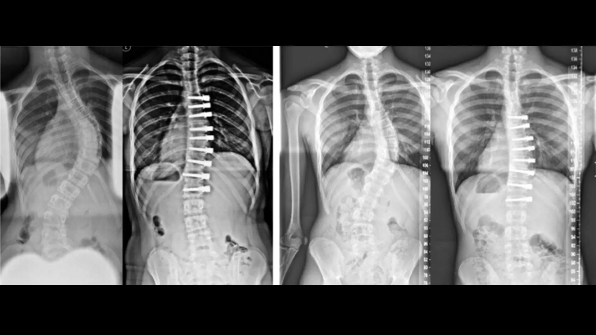 Images of two patients who were treated using the Zimmer Biomet Spine, the Tether™ Vertebral Body Tethering System 

