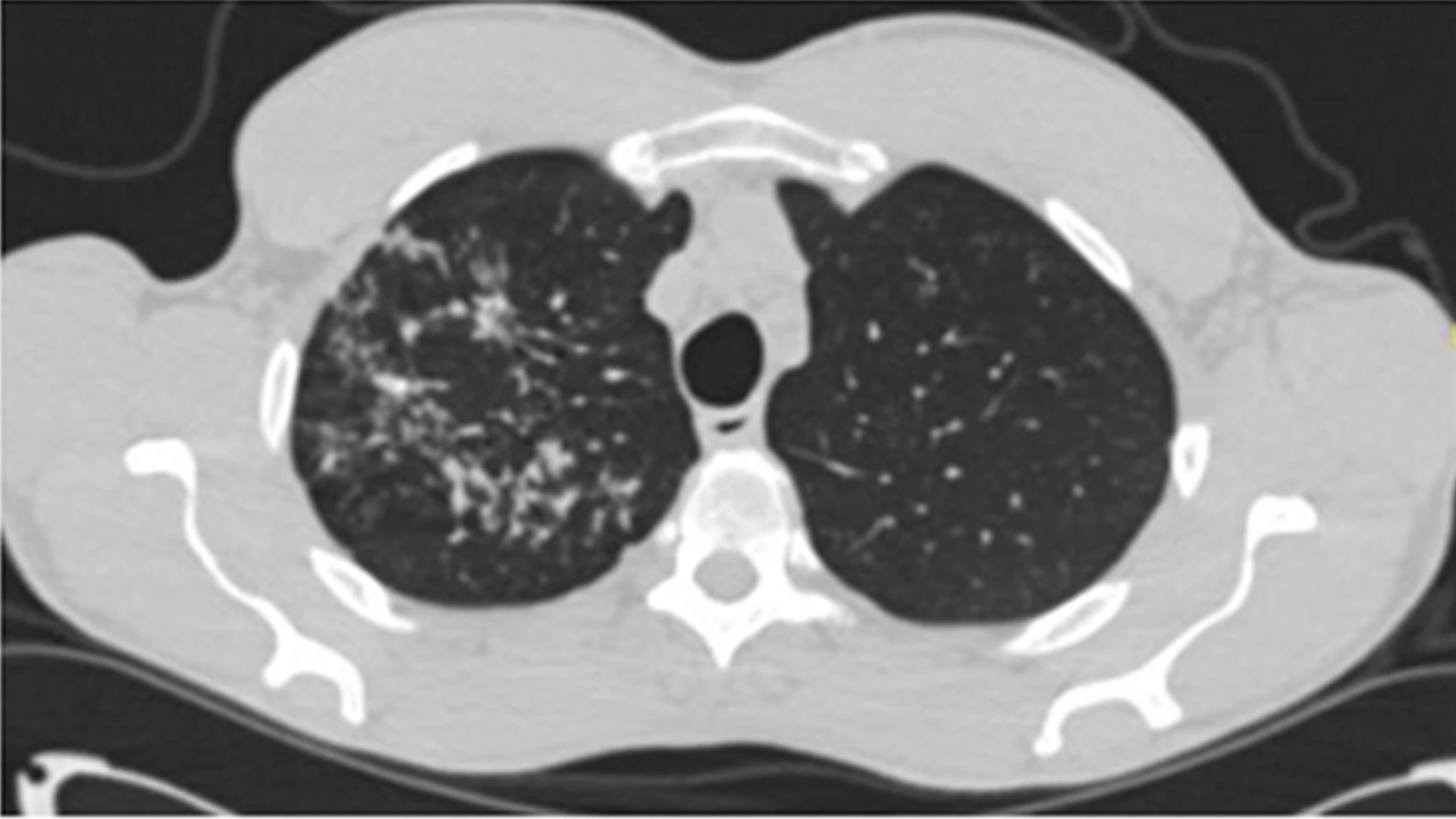 The chest CT also showed a nodular infiltrate in the right upper lobe. A bronchoscopy was performed and obtained positive cultures for tuberculosis.