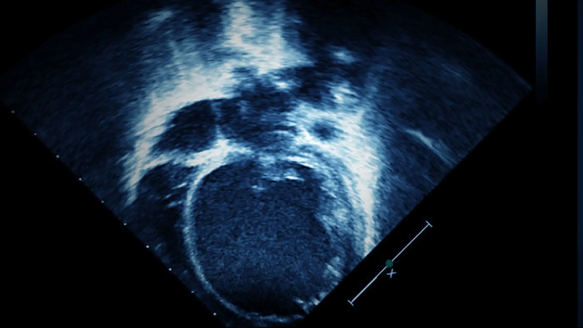 How a Baby in Heart Failure Received a Transplant as the COVID-19 Pandemic Ravaged New York City Hospitals