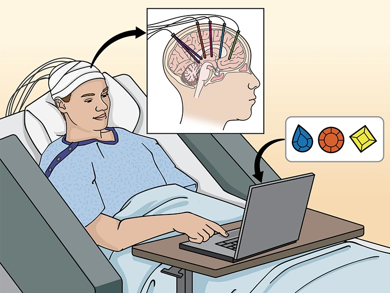 Figure 1. Neurosurgical approaches to the study of human cognition. Epilepsy patients undergo invasive monitoring for the localization of seizure onset zones, which requires implantation of electrodes capable of monitoring brain electrical activity in multiple brain areas. Combined with behavioral tasks and computational models, this allows for direct investigation of the neurobiological basis of human behavior and cognition. By having monkeys perform in some cases the identical cognitive tasks (see related article) it is possible to move bidirectionally from humans to animals and back to humans to establish causal mechanisms. Credit: J Gregory, Mount Sinai Health System