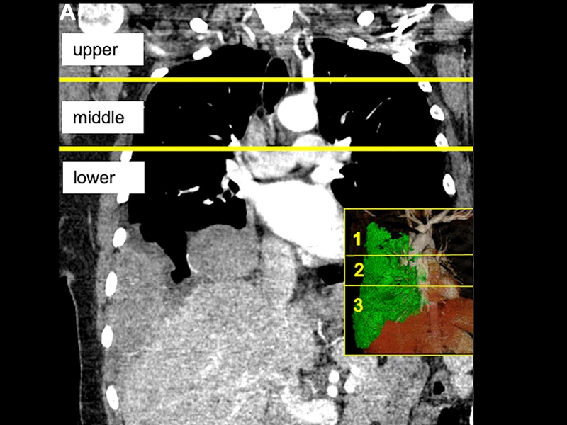 Coronal and sagittal images of patients with pleural mesothelioma illustrating division of the chest into approximate thirds by a line drawn at the level of the aortic arch and a second line at the top of the left atrium, dividing the chest into three relatively equal parts of upper, middle, and lower levels. The maximum pleural thickness on each of these levels (Pmax1, Pmax2, and Pmax3) is measured and combined to derive a sum of maximum pleural thickness (Psum=Pmax1 + Pmax2 + Pmax3). 