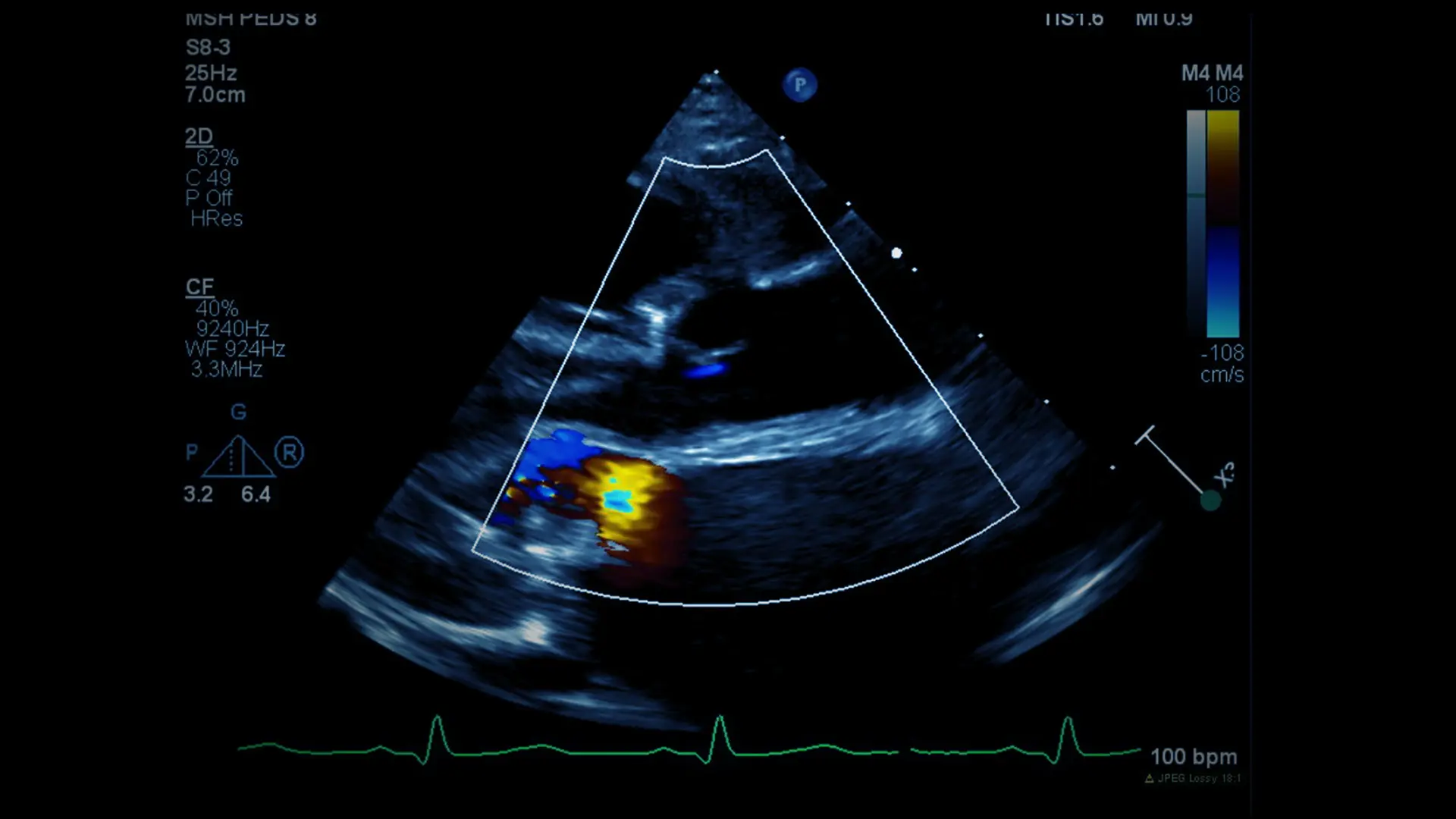 Patient Liba’s Case: Mount Sinai Repairs Two Heart Valves in One Procedure