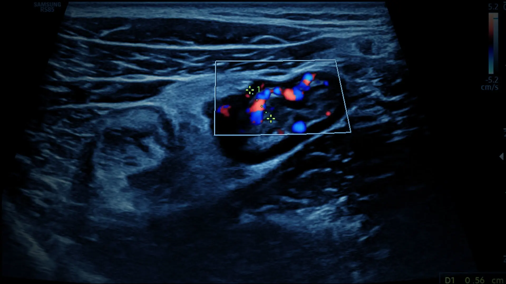Bringing Ultrasound to the Bedside to Rapidly Diagnose and Treat IBD