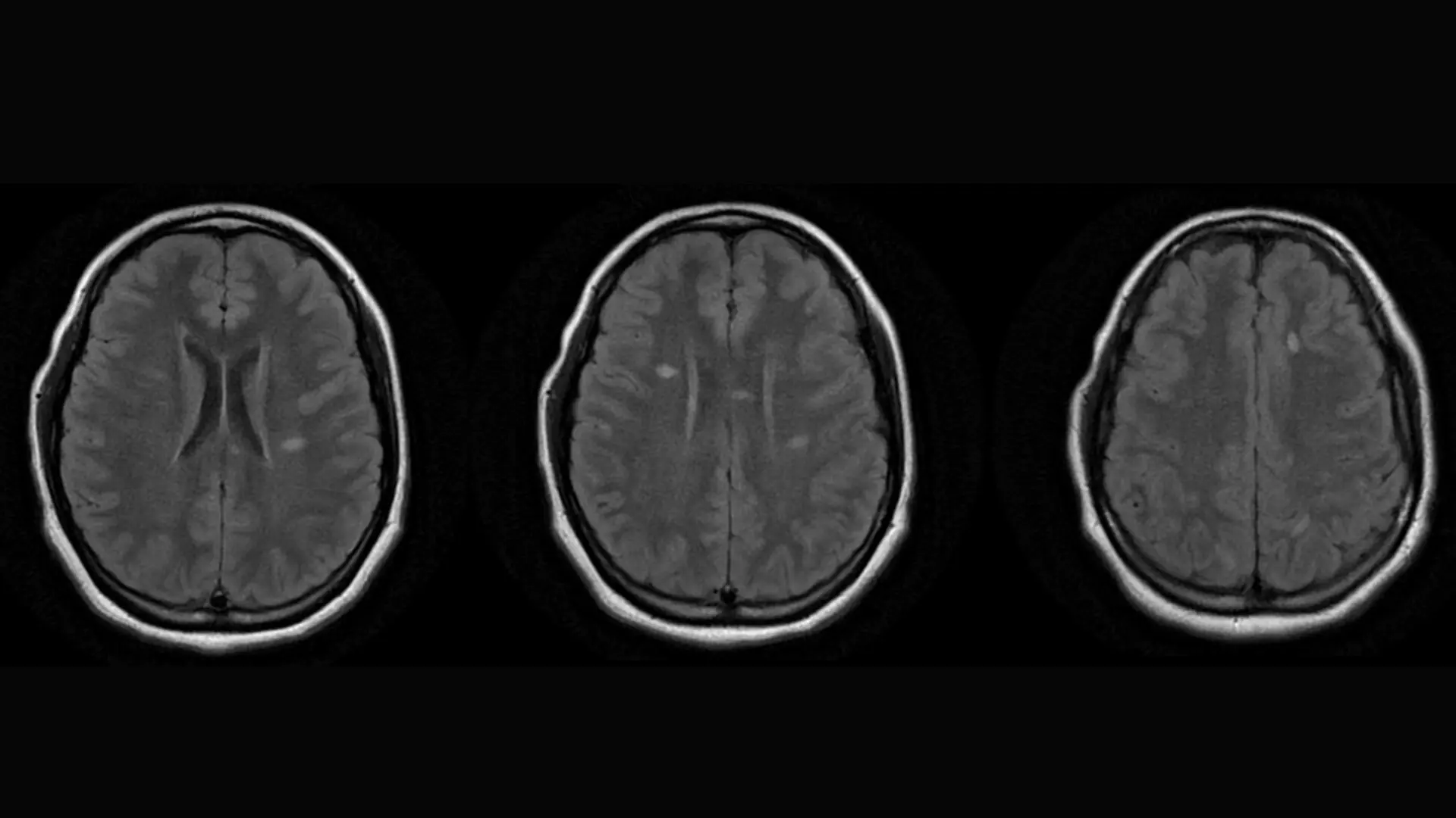 Magnetic resonance imaging (MRI) of a young patient with the anti-NMDA receptor
encephalitis form of autoimmune encephalitis demonstrating scattered, ovoid T2
hyperintense lesions within the periventricular, subcortical, and juxtacortical white matter (also seen in the infratentorial brain).