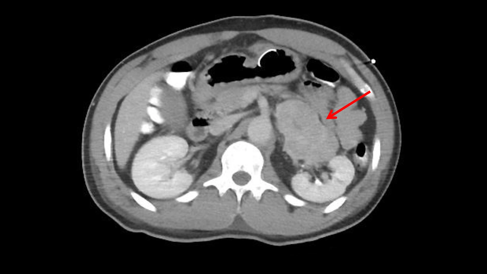 Adrenocortical carcinoma is adjacent to the left kidney on the CT image.