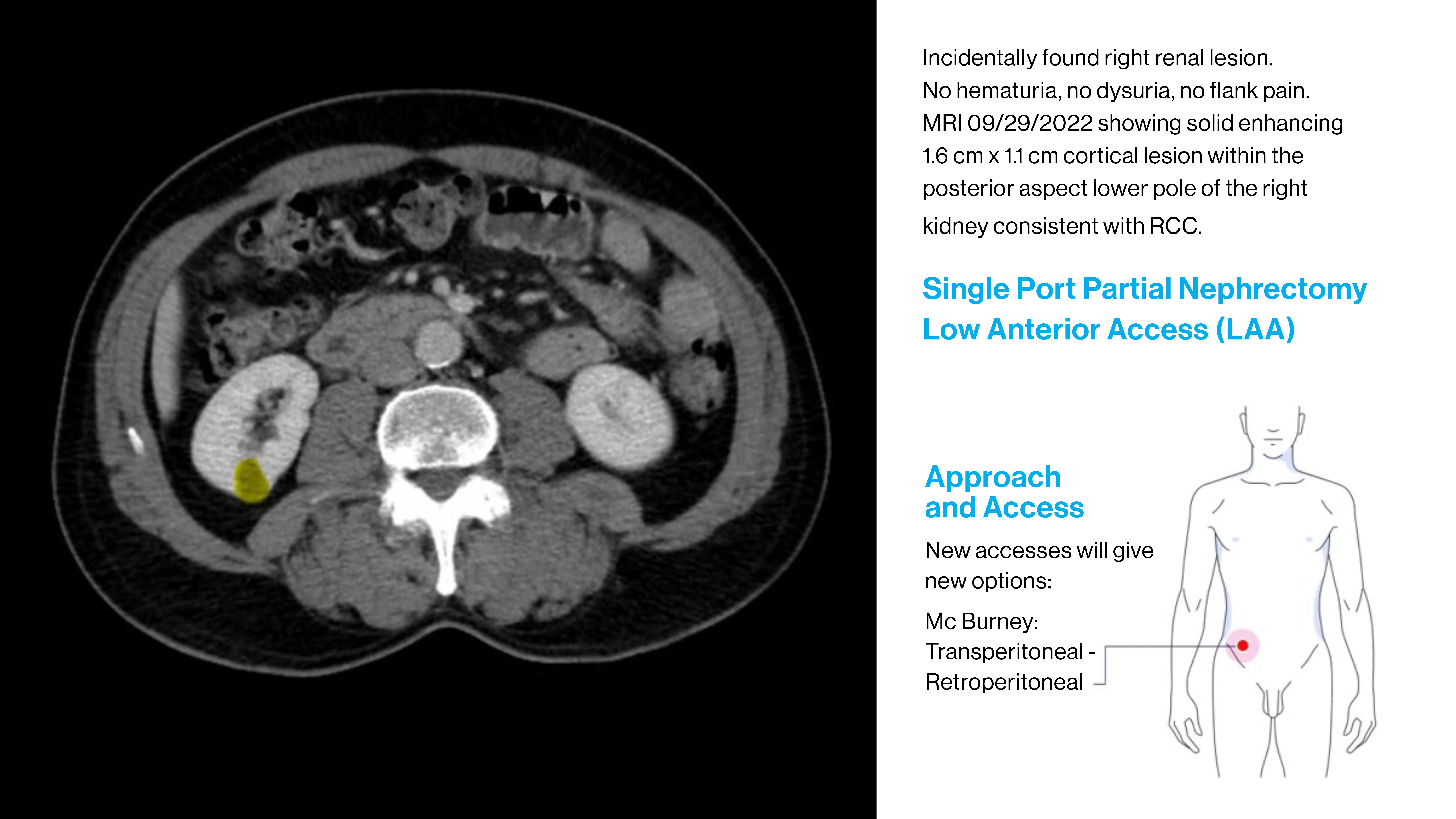 This slide describes a kidney cancer patient who is a good candidate for single-port robotic surgery.