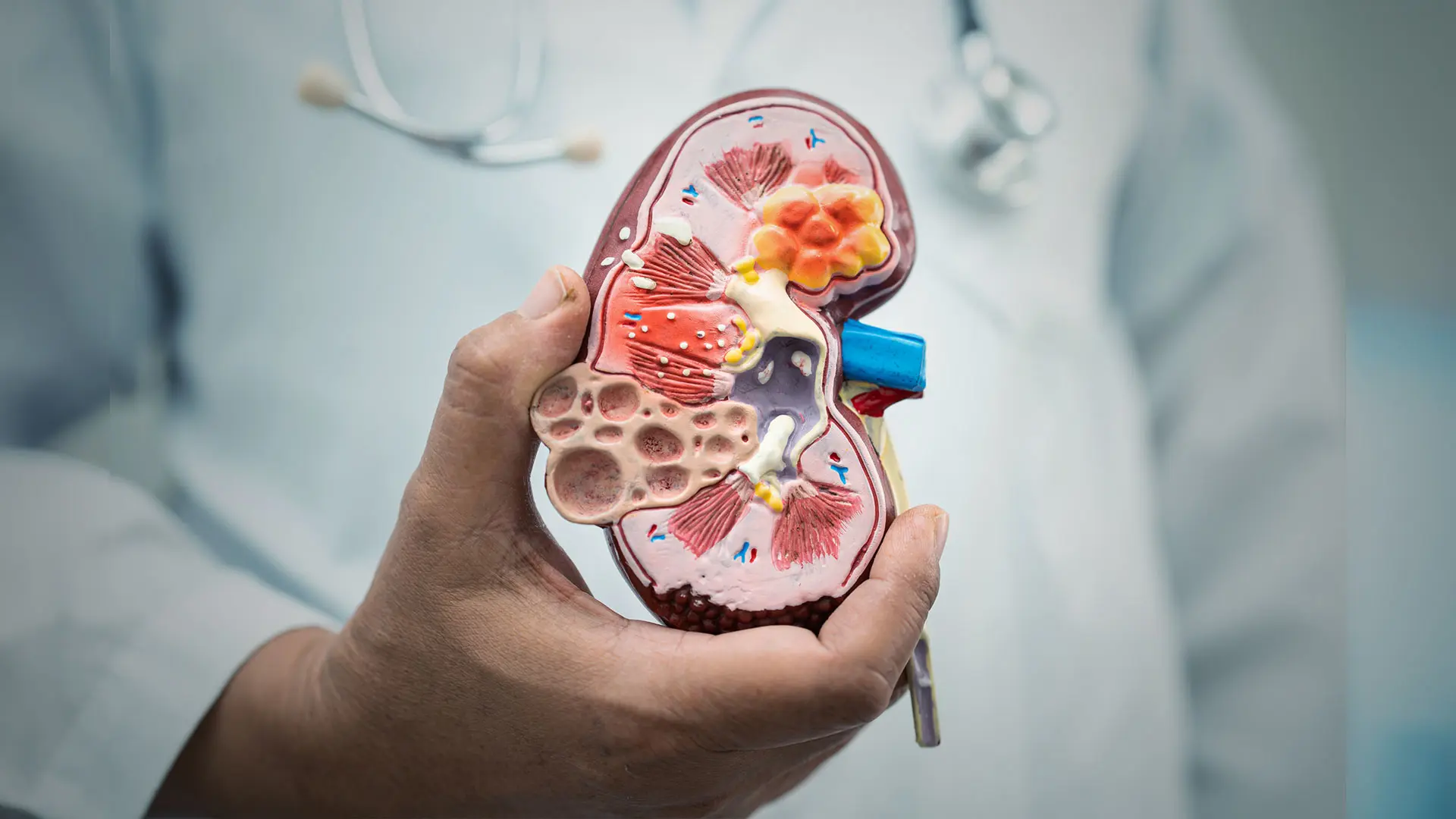 New Technique for Kidney Stone Removal Yields Significant Gains in Safety and Outcomes