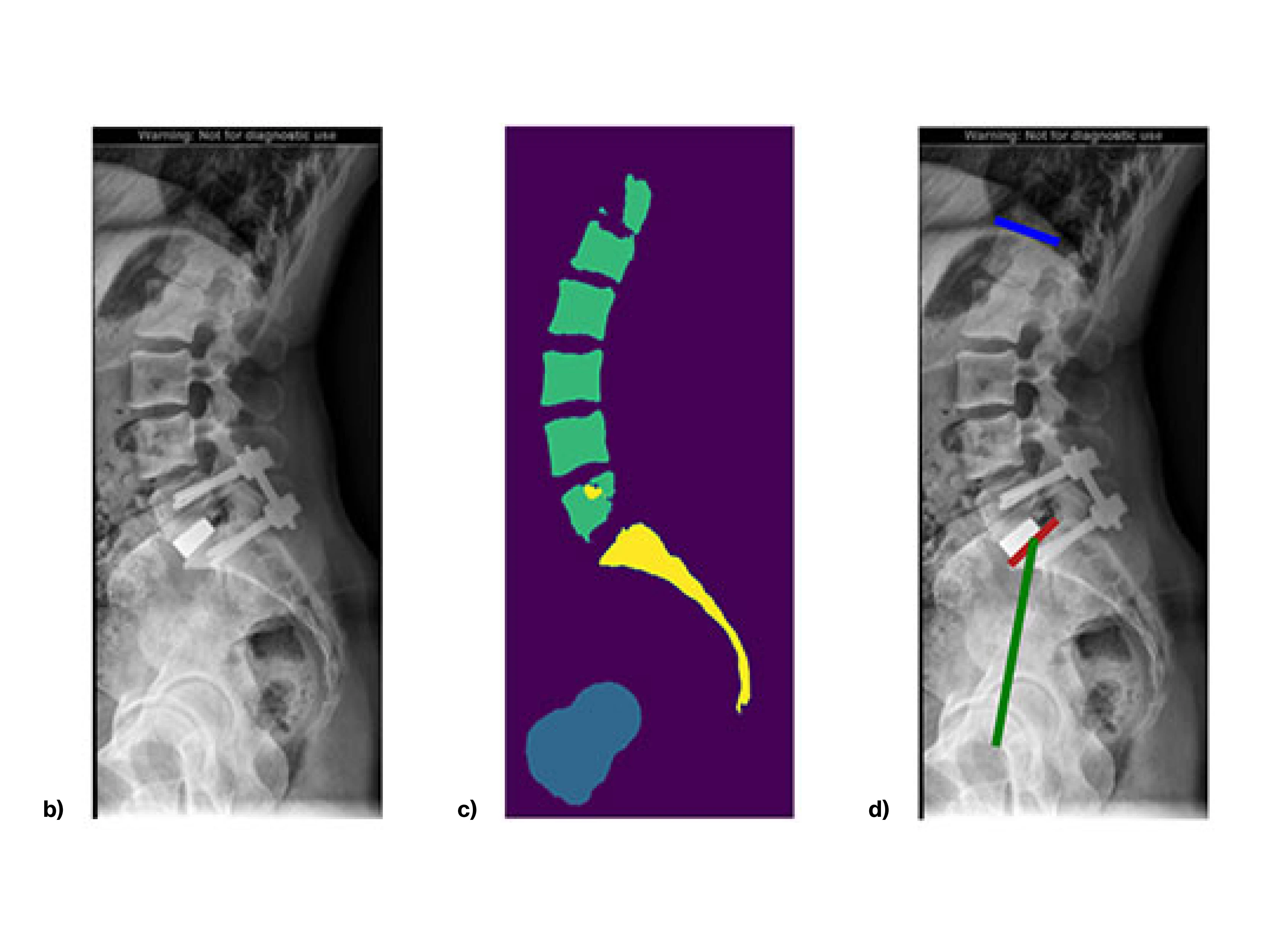 b) An input image example.  c) An algorithm-generated segmentation example.  d) An algorithm-generated measurement visualization example. Blue line indicates superior endplate of L1. Red line indicates the superior endplate of S1. Green line connects the midpoint of the S1 superior endplate with the axis of the femoral heads. 

