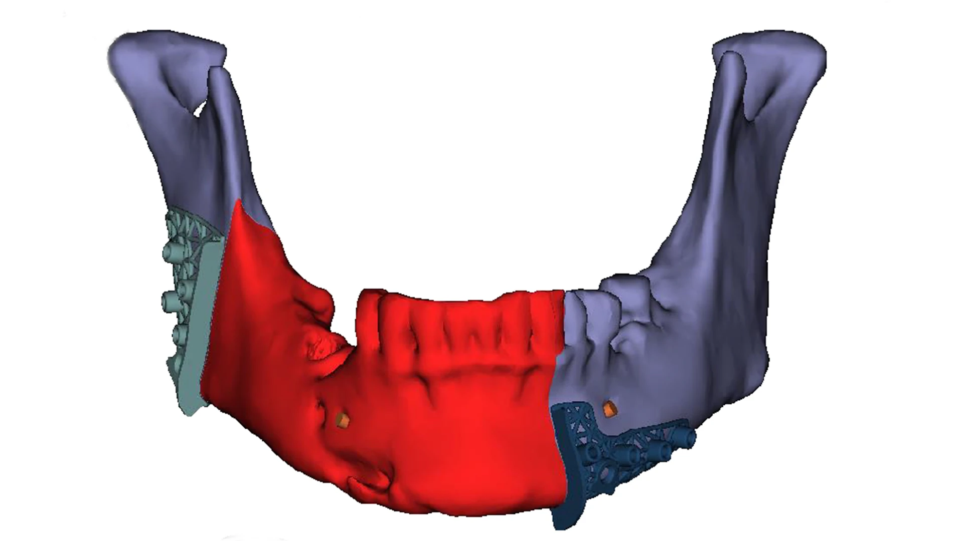 Planned removal of the diseased portion of the mandible (red).