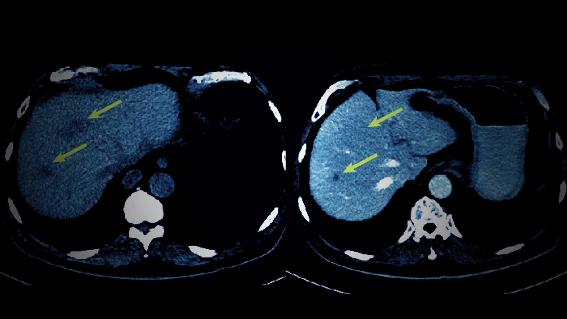 Personalized Cancer Vaccine Shows Promise in Multiple Studies