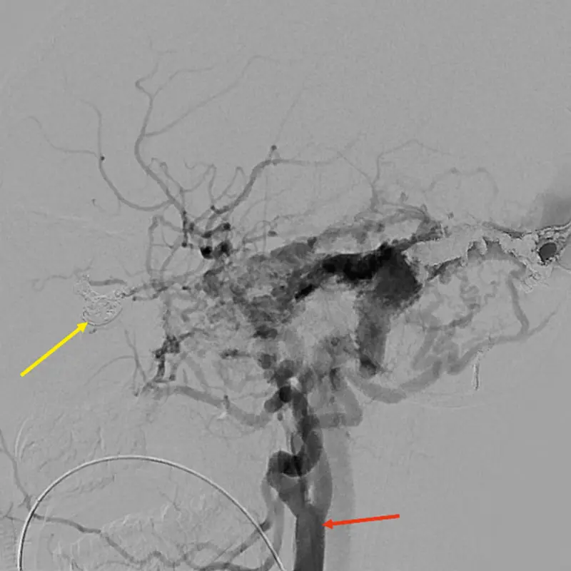 Post-treatment angiogram showing closure of the AV fistula. Yellow arrow: Platinum coil material inside the AV fistula blocking the flow of blood between the artery and vein; red arrow: Right common carotid artery