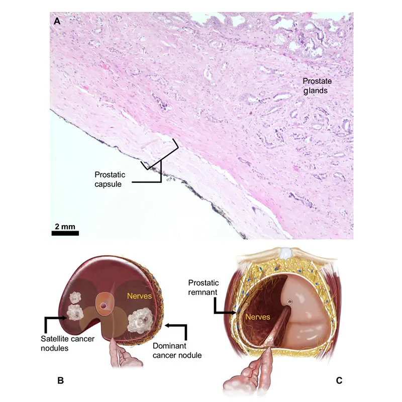 Image A shows the prostate capsule under a light microscope, the layer in which many nerves critical for erection travel; Image B shows the removed specimen during the operation; Image C shows what is left behind, the remnant with the critically important erectile nerves.
