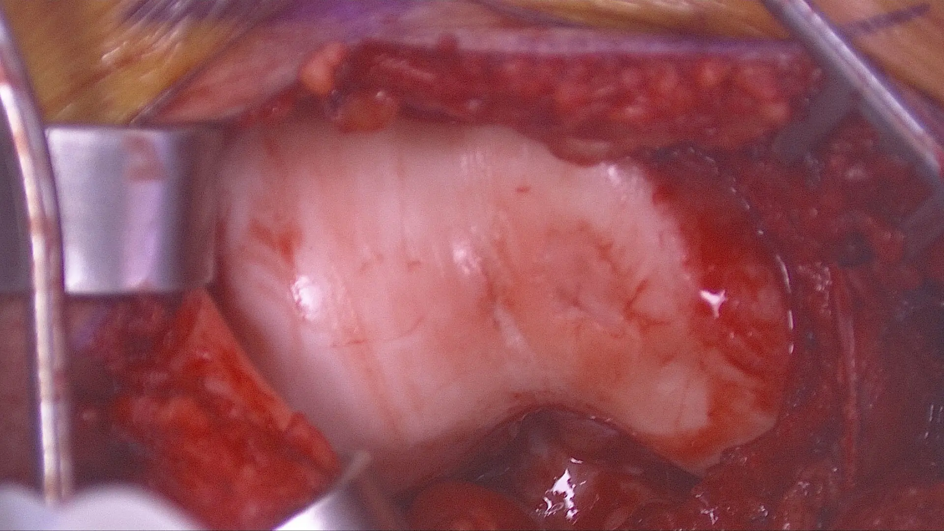 Cartilage damage on the end of the trochlea through which the kneecap (patella) glides when the knee bends and extends.