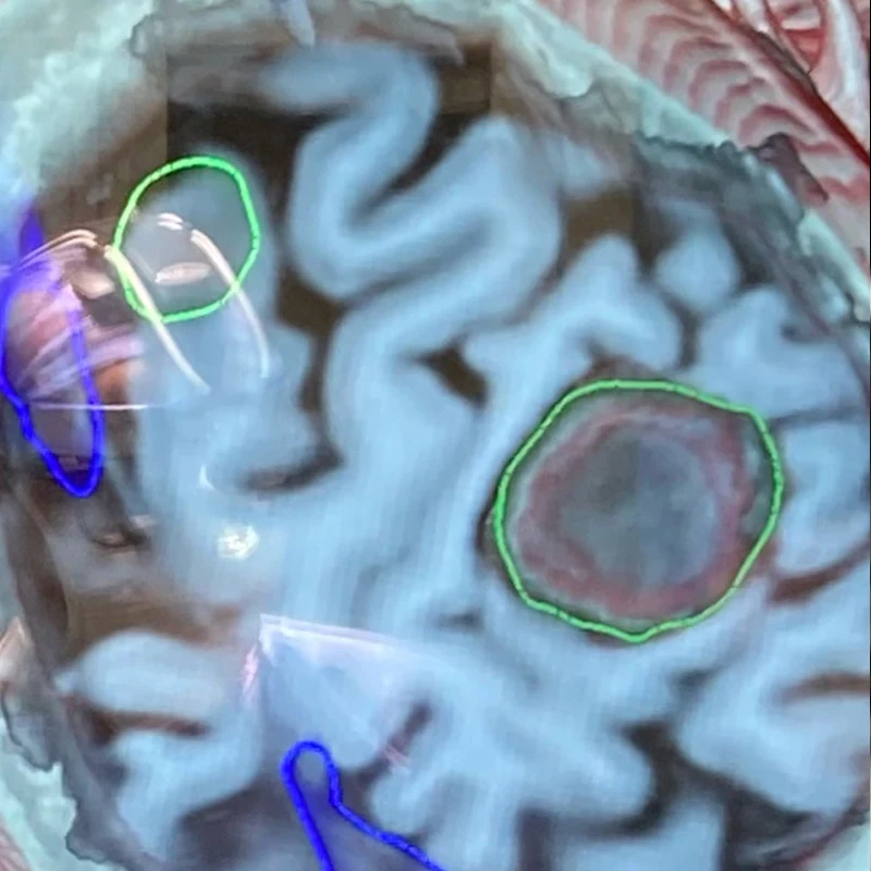 Middle Center. Oblique cross-section through the T1-weighted MRI highlighting the tumor, green, right, compressing the postcentral (sensory) gyrus.