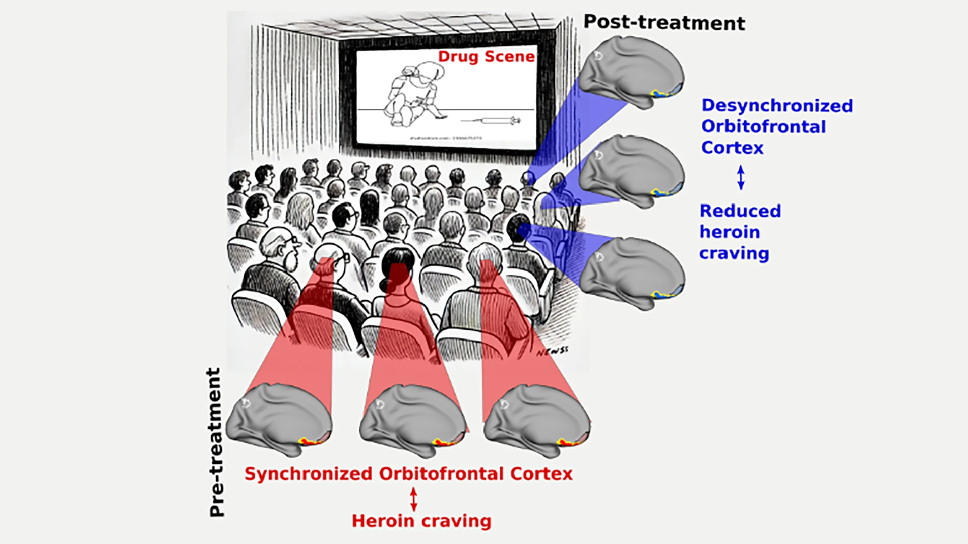 A graphical representation of the study: Prior to treatment, patients with heroin use disorder, when viewing scenes with drug cues from the movie Trainspotting, exhibited synchronized activity in their orbitofrontal cortex—displayed in red and yellow highlights. Post-treatment, the same brain regions of the patients showed a more desynchronized activity, which is correlated with reduced heroin craving.