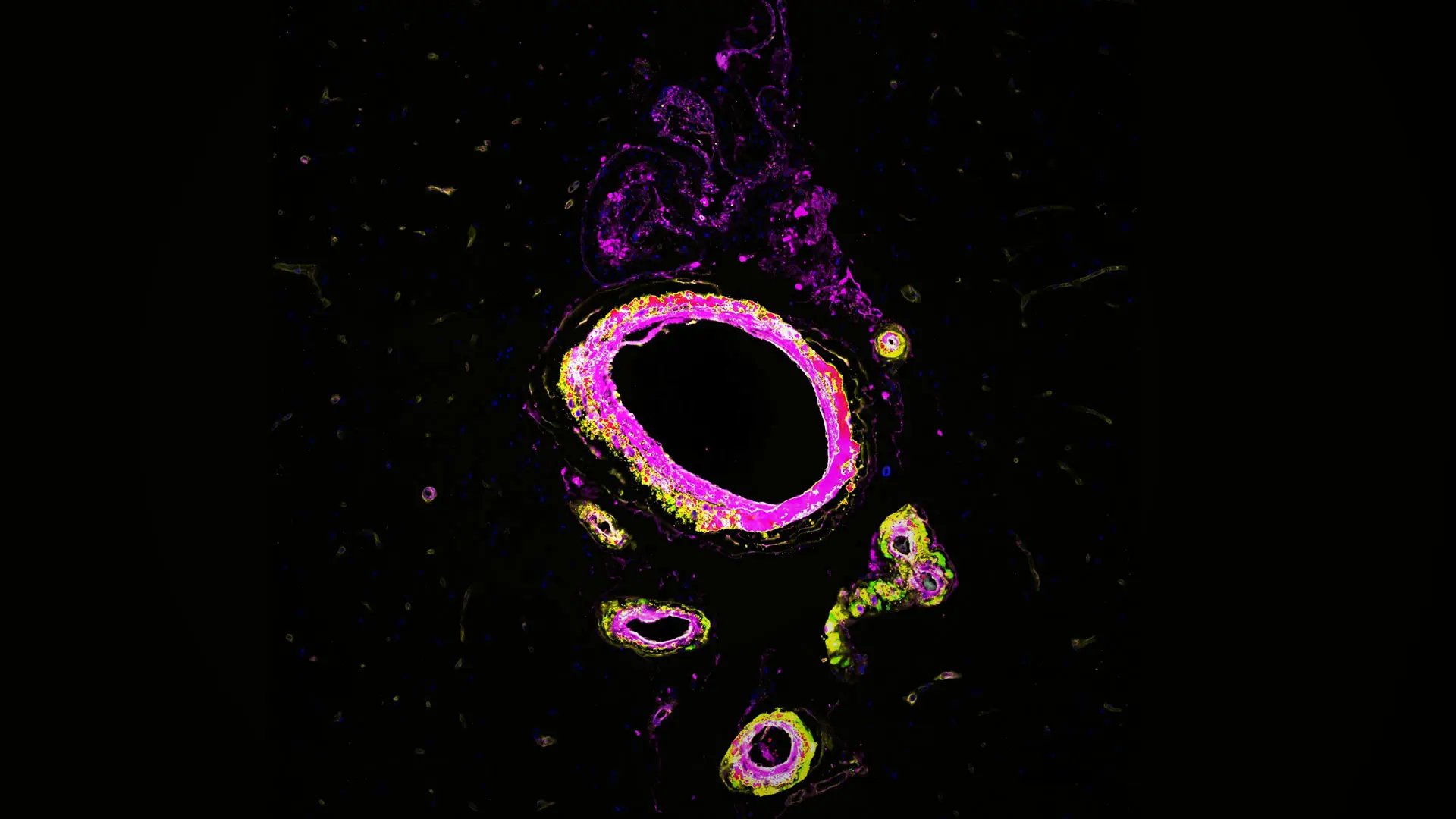 Blood-Based Biomarkers of Age-Related Brain Disorders: New Insights on Role of Vascular Dysfunction