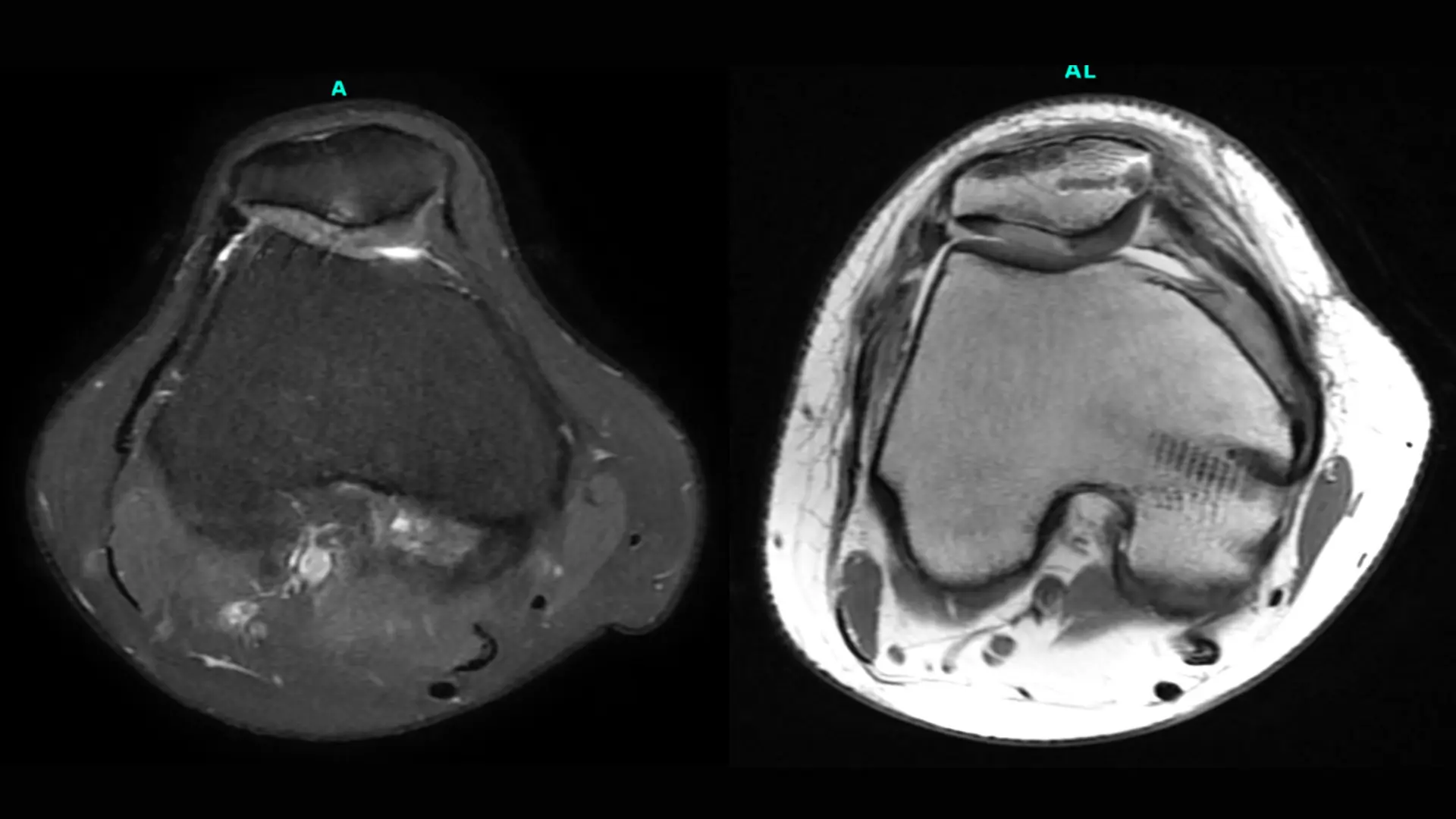 Preoperative (left) and three-month postoperative (right) MRI axial images depicting incorporation of the patient’s cell-based cartilage graft as well as her MPFL reconstruction.