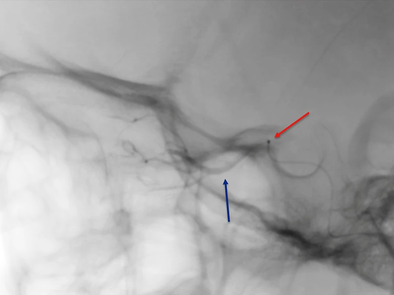 X-ray showing delivery of intra-arterial chemotherapy agent. The red arrow is showing the microcatheter tip in place and blue arrow is pointing to dye in the ophthalmic artery.