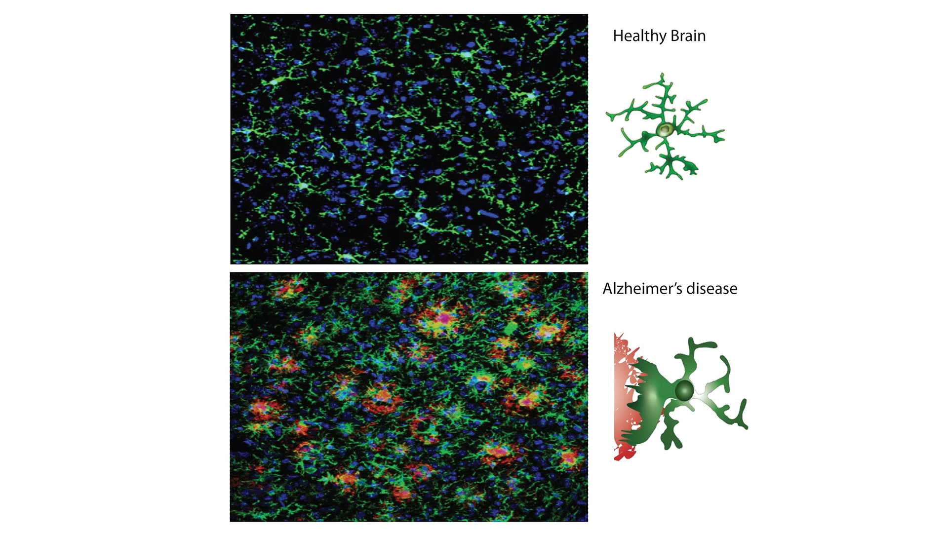 Figure 2. Microglia activation in Alzheimer’s disease (AD). Microglia (green) in the cortex of a healthy brain (top) become activated in the cortex of a mouse model of AD (bottom, blue cell nuclei). Schematic shows microglial activation and morphology changes when responding to beta-amyloid plaques (red).