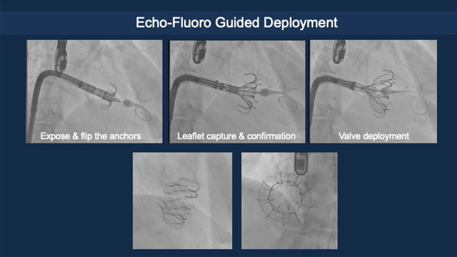 Deployment of the Evoque device, guided by echo-fluoro imaging.