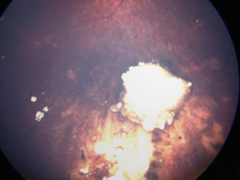 Fundus photo of the right eye after treatment showing completely calcified (dead) retinal tumor with calcified (dead) vitreous seeds.