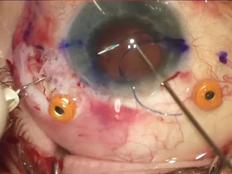 Scleral fixation of intraocular lenses using the Yamane technique.