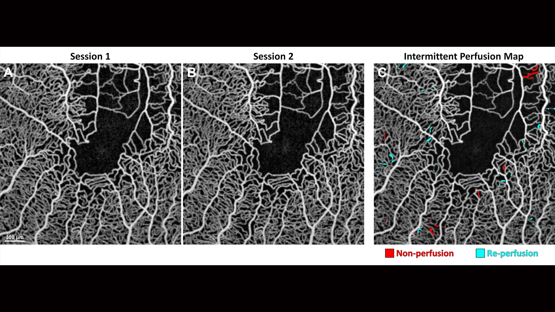 Averaged OCT angiography images of a sickle cell disease patient collected at (A) baseline and (B) one-hour follow-up. (C) Intermittent perfusion map shows capillary non-perfusion in red and re-perfusion in cyan over one hour.