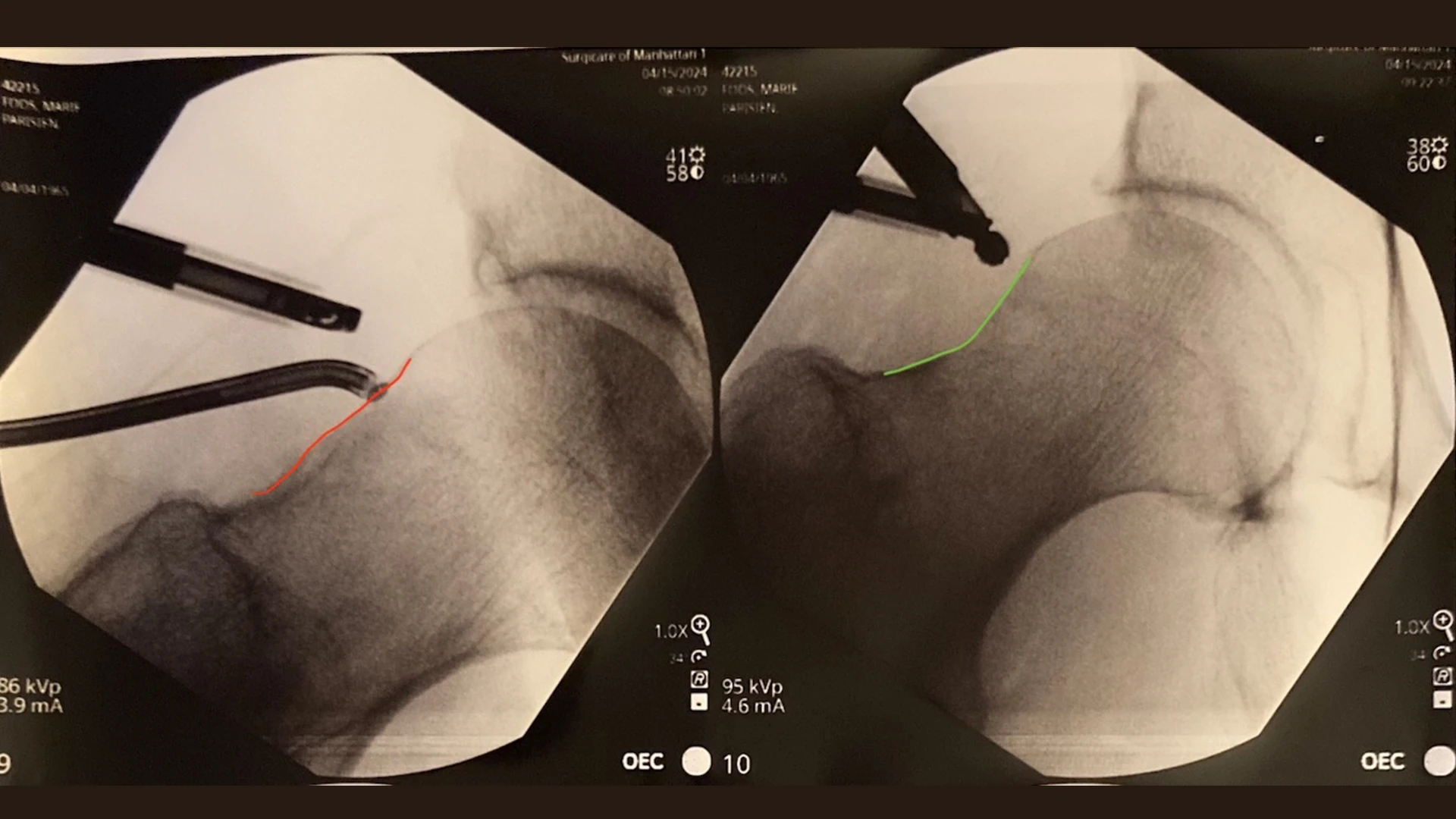 Intraoperative fluoroscopic imaging demonstrating a CAM lesion (red) and appropriate CAM resection (green).