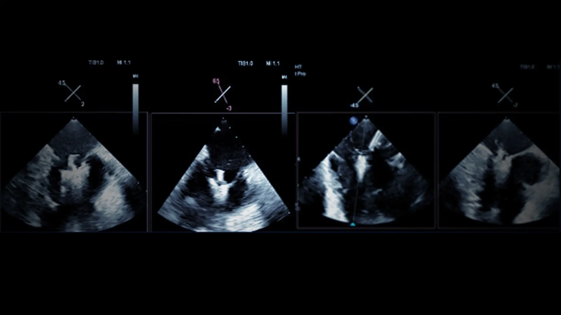 Mount Sinai Shifts Standard of Treatment for Severe Tricuspid Regurgitation With New, Nonsurgical Options 