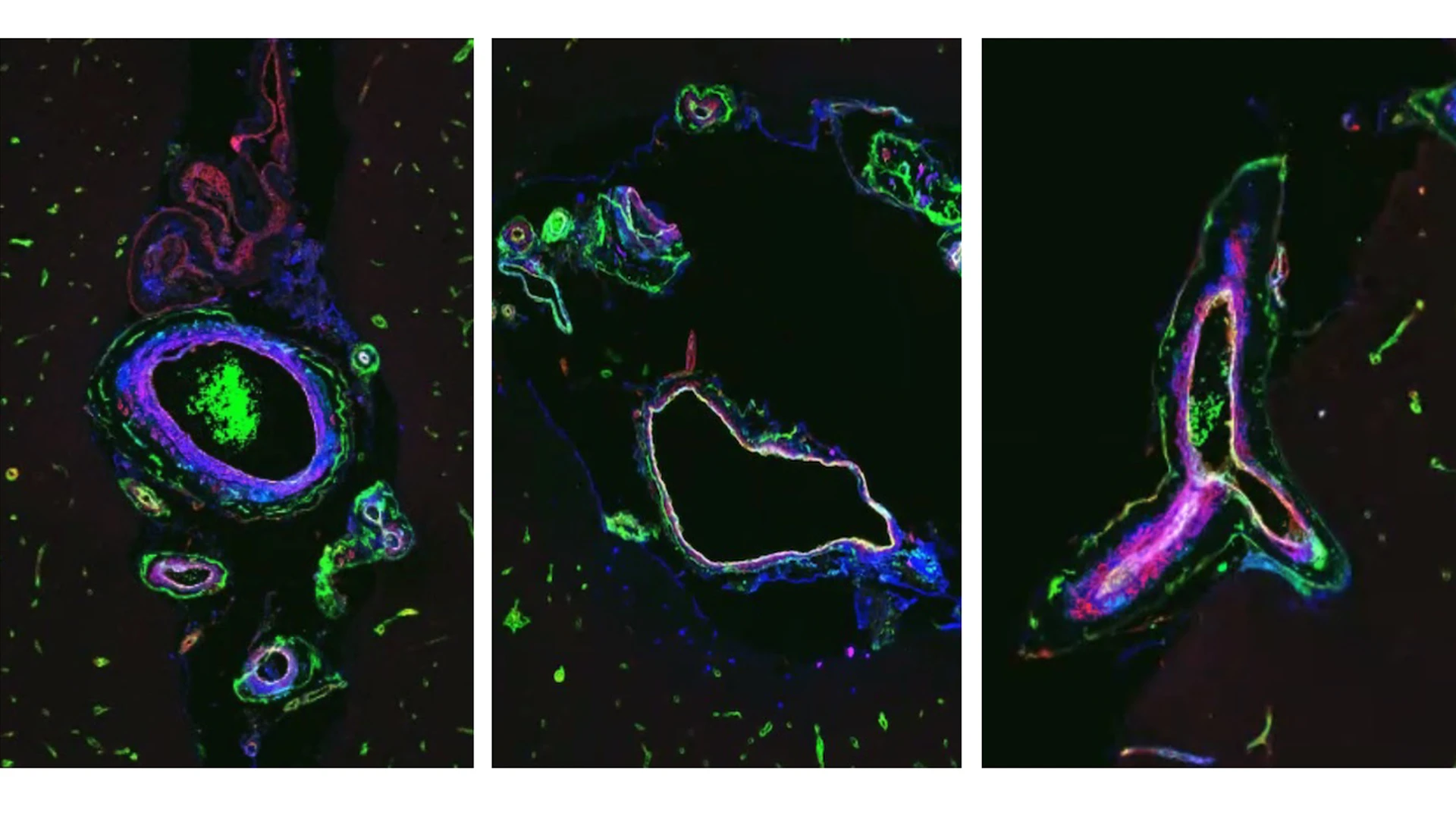 Figure. Multiplex immunohistochemistry reveals expression of key proteins from the vascular disease blood signature within brain blood vessels of a brain impacted by a monogenic form of accelerated vascular aging and dementia. DAPI marking nuclei (blue), C4A (green), FN1 (yellow), VEGFR1 (red), and CD105 (light blue).