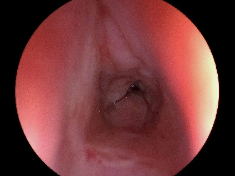 A patient that was previously intubated for COVID-19 who has developed subglottic stenosis. 



