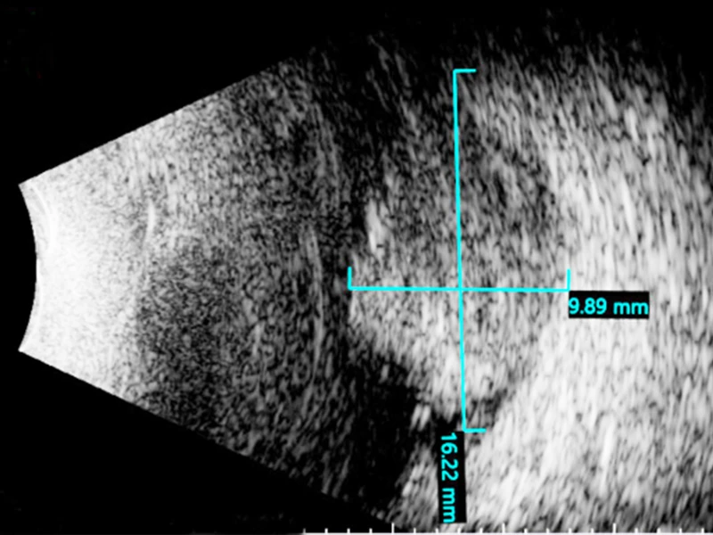 Ultrasound of the retinal tumor measuring 9.9 x 16.2 mm in size before the treatment.