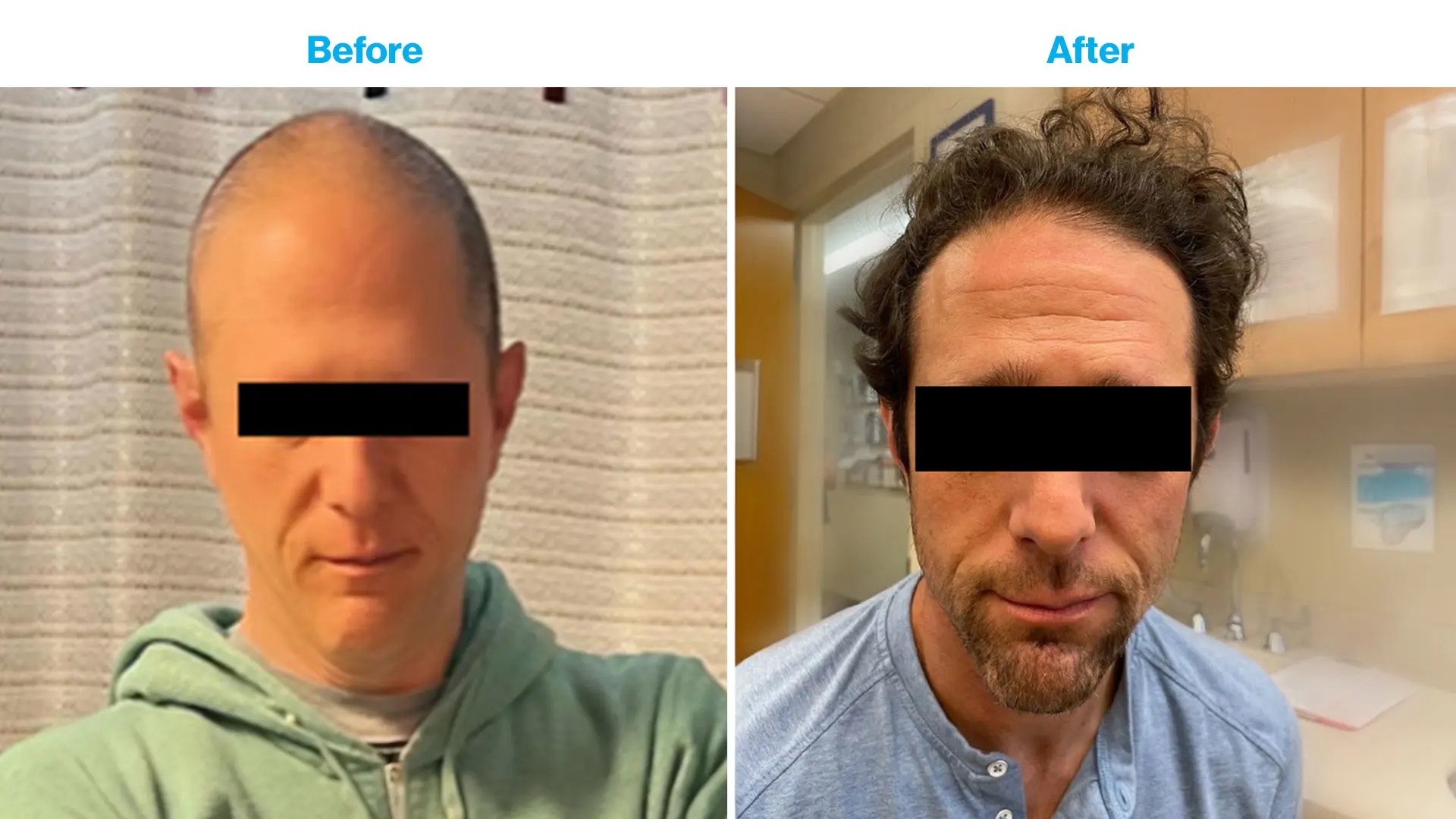 This patient had total hair loss five years ago, and is shown before and after treatment
provided by Emma Guttman, MD, PhD.
