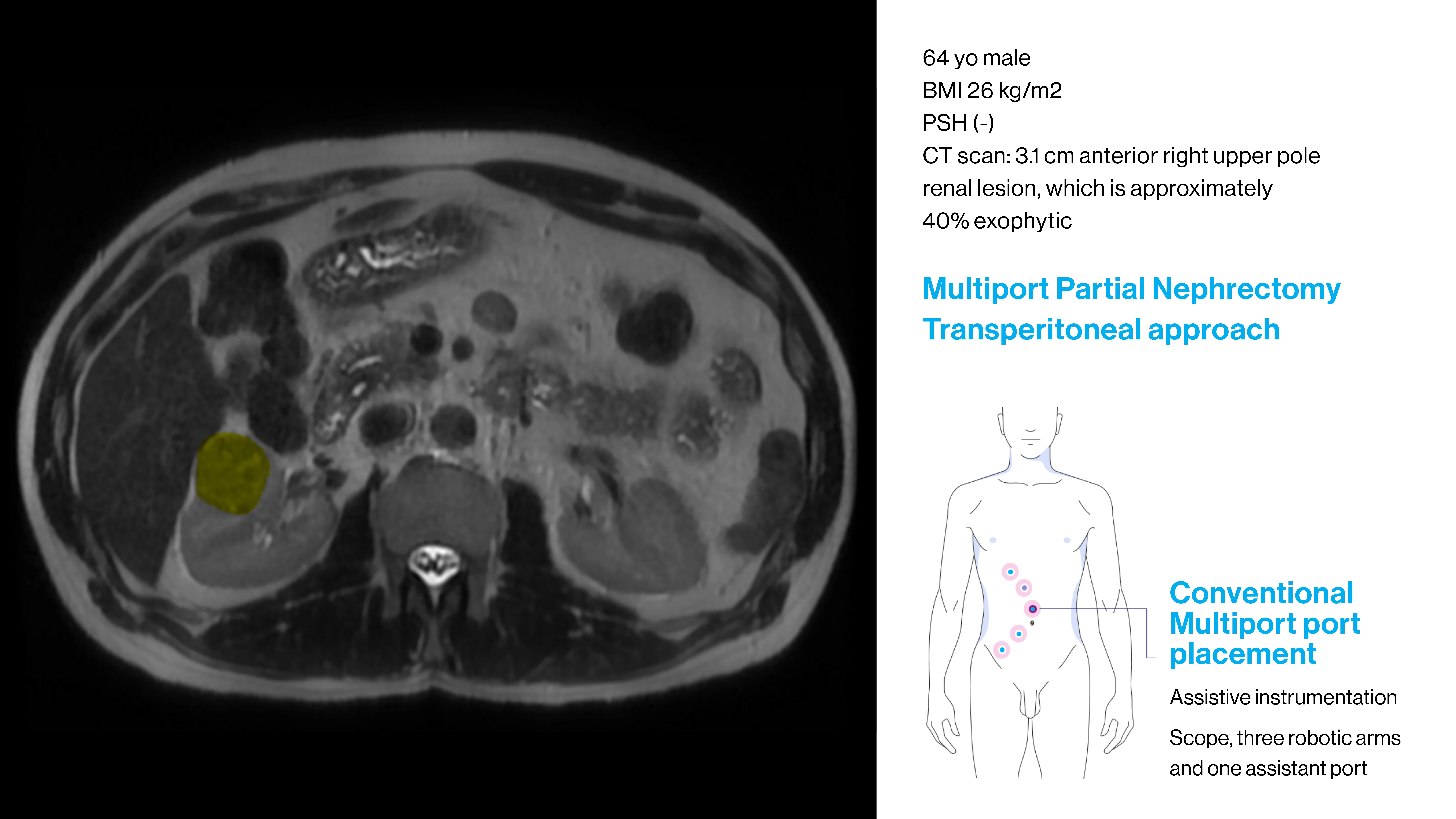 This slide describes a kidney cancer patient who is a good candidate for multiport robotic surgery. 